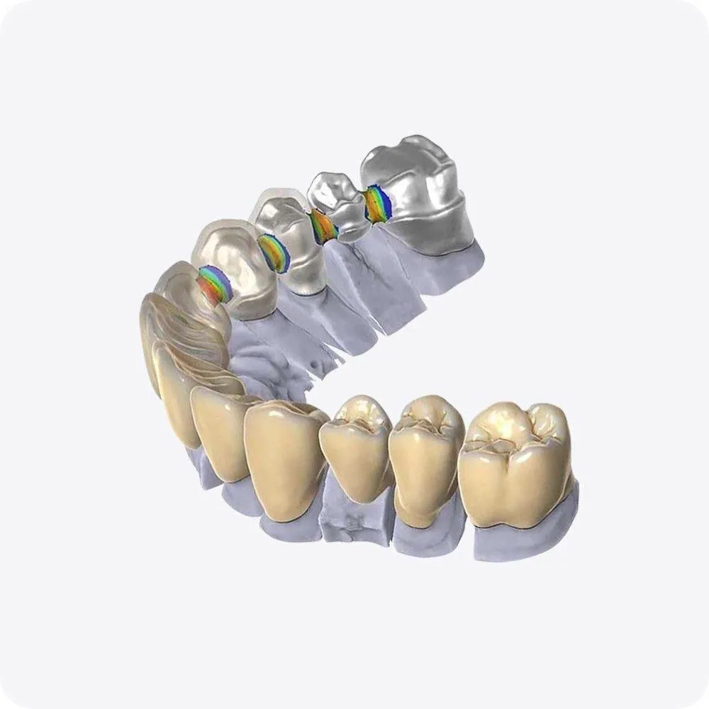 Full arch of CAD crowns and bridges with contact-point heat maps