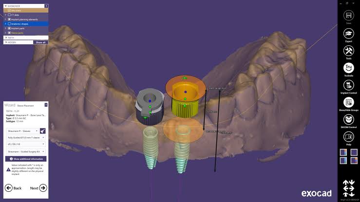 Guided implant sleeve planning wizard positioning sleeves on a digital arch