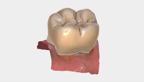 Molar crown design seated on the prepared margin