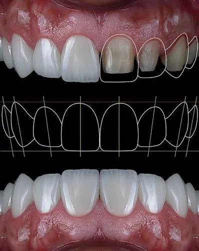 Before and after smile design for veneers