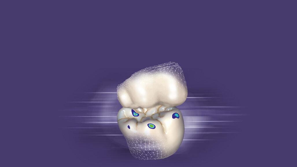 CAD occlusal contact mesh mapping clearance against the antagonist teeth
