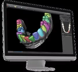Aligner treatment staging shown on a monitor
