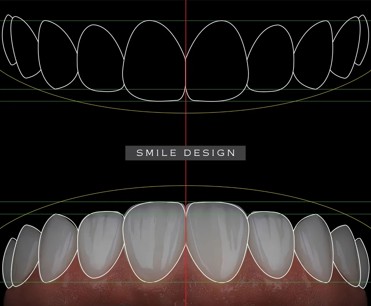 Digital smile design outlines of upper anterior teeth
