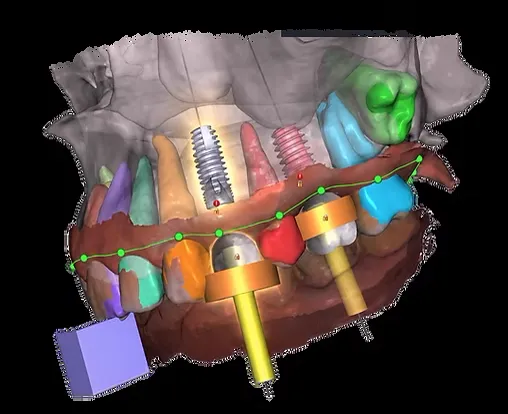 Implant surgical planning with guided sleeves on a 3D model