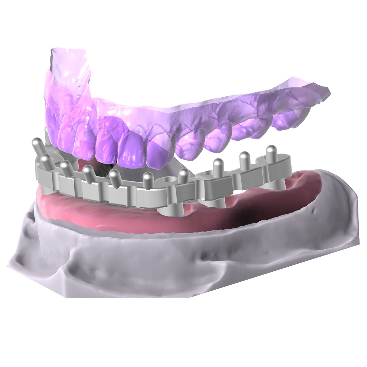 Multi-unit implant bar module designed for a full-arch restoration