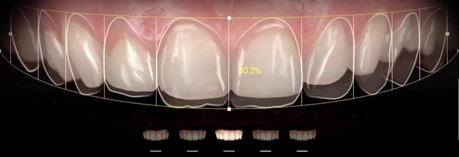 Digital smile design proportion grid over a patient's smile