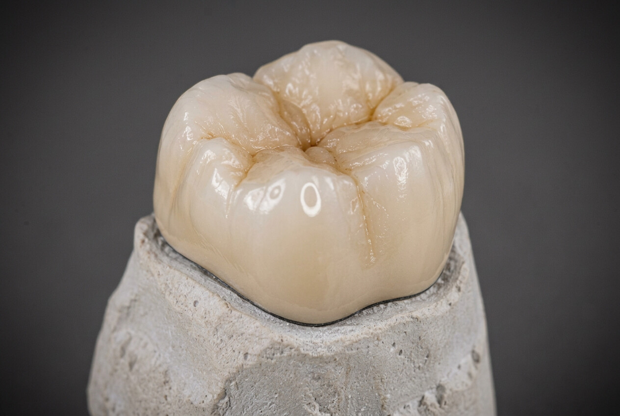 Printed dental model with multiple finished zirconia crowns seated